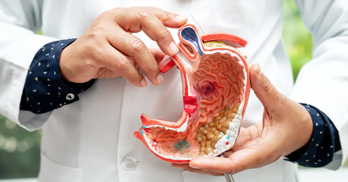 A doctor holding a 3D anatomical model of the human stomach, highlighting digestive health conditions and treatment options.