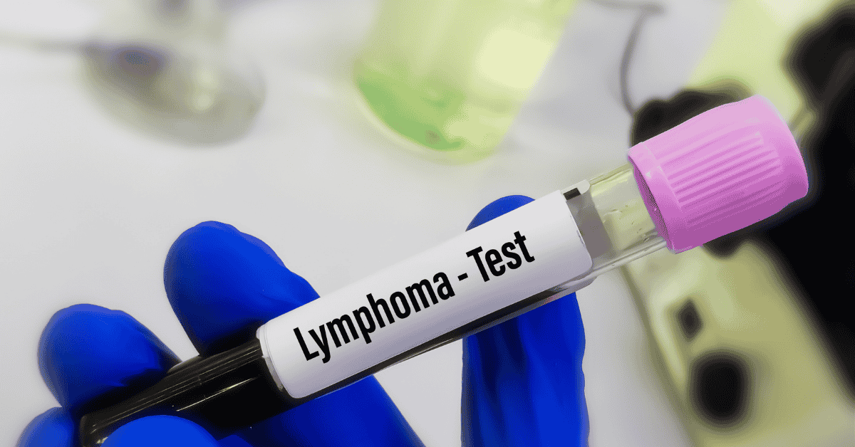 Lymphoma Treatment Costs and Insurance Coverage in Singapore
