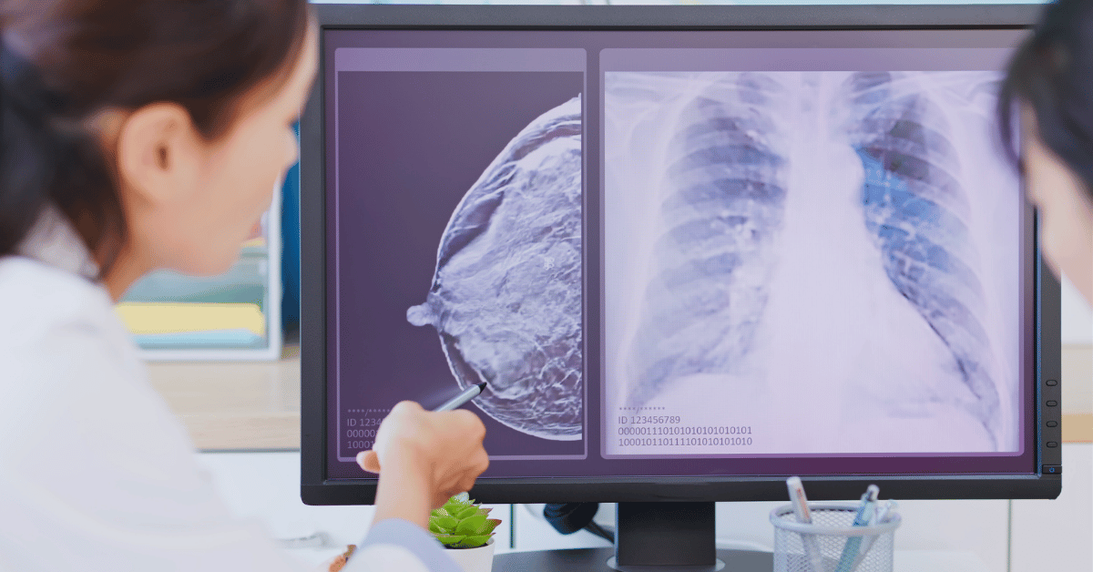 Breast Cancer Treatment Costs and Insurance Coverage in Singapore