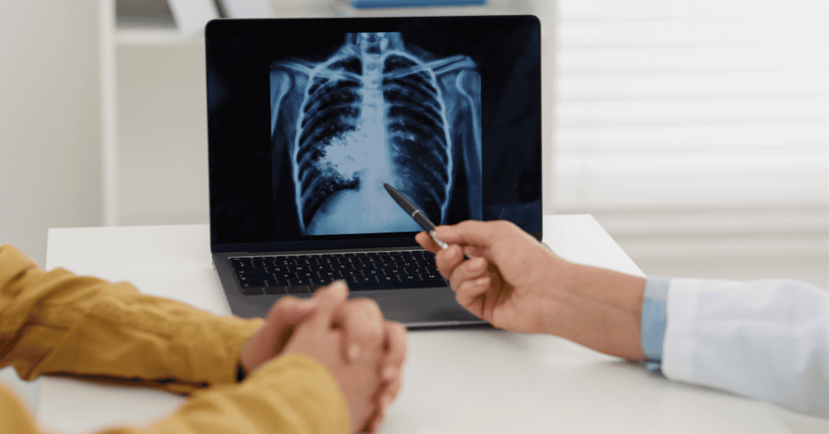 Lung Cancer Treatment Costs and Insurance Coverage in Singapore