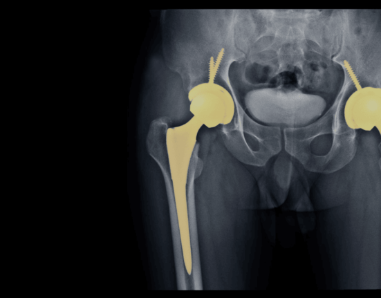 Hip Replacement Surgery in Singapore: Costs, Insurance Coverage & What to Expect