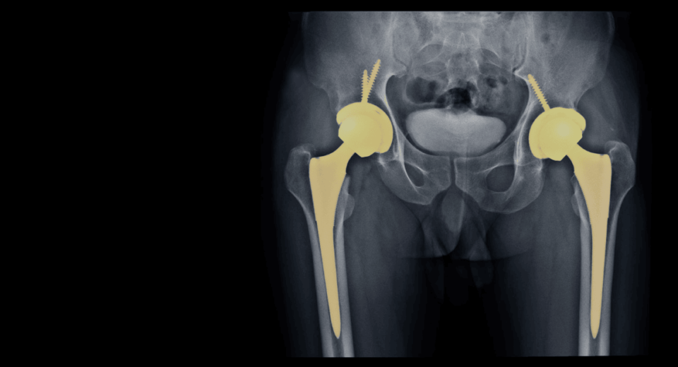 Hip Replacement Surgery in Singapore: Costs, Insurance Coverage & What to Expect
