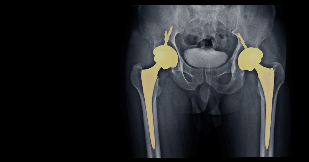 Hip Replacement Surgery in Singapore: Costs, Insurance Coverage & What to Expect