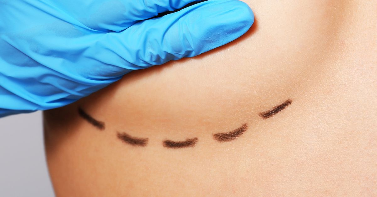 breast augmentation scars