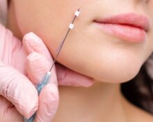 face lift thread singapore