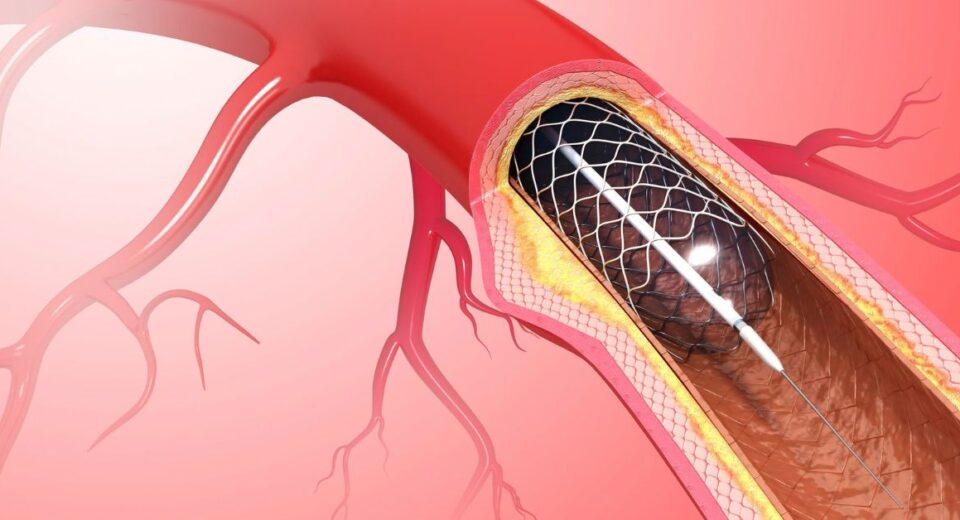 Angioplasty And Stent Placement for the Heart