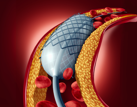 Coronary Angioplasty 1