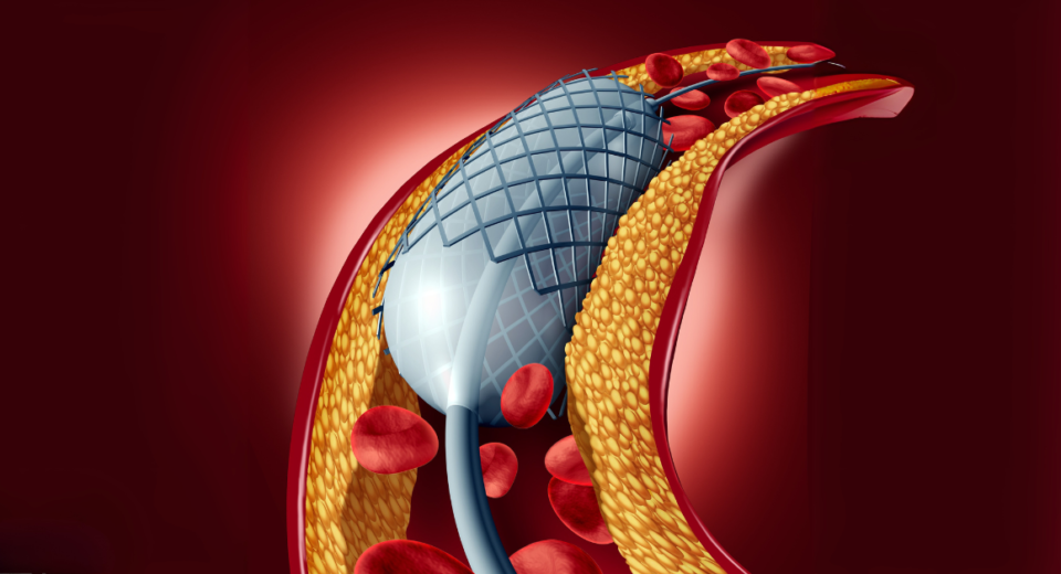 Coronary Angioplasty 1