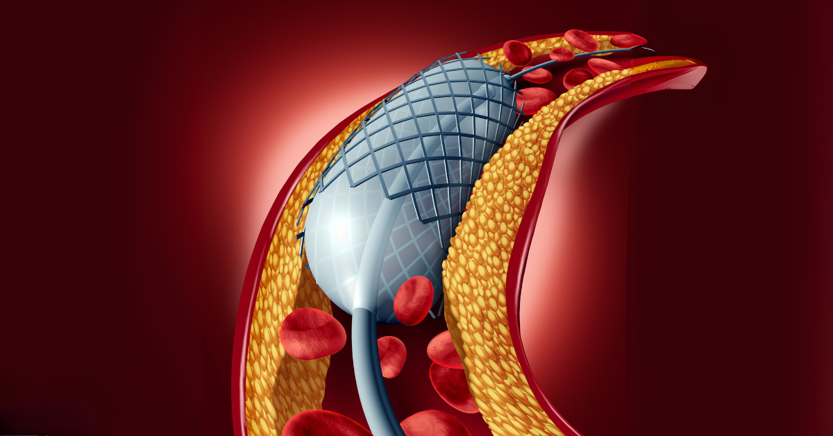 Coronary Angioplasty 1