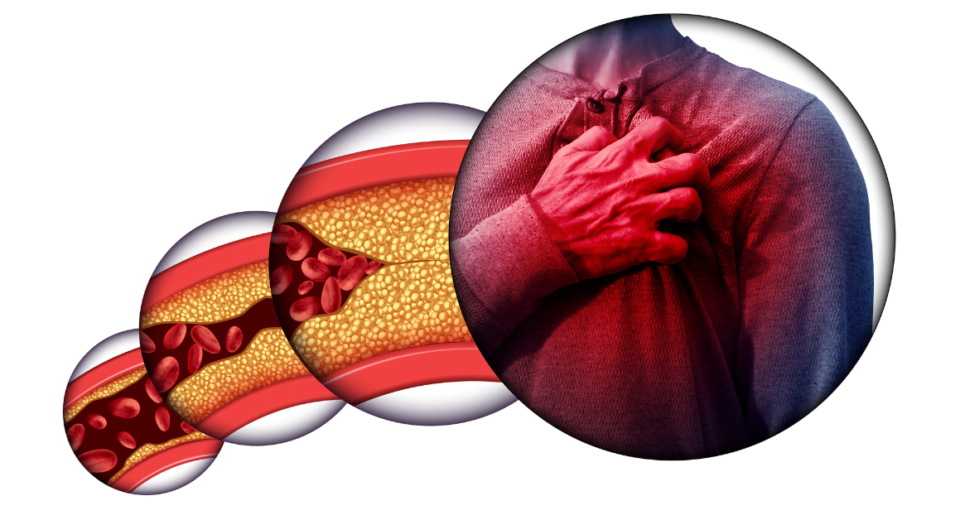 Coronary Heart Disease 1