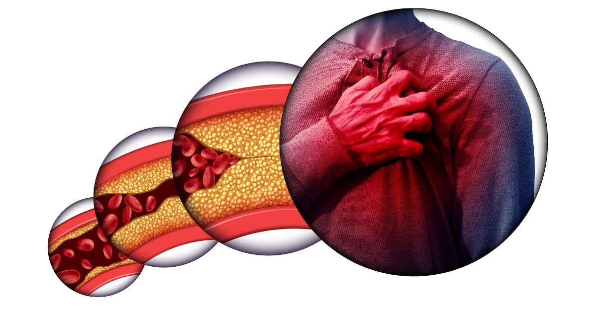Coronary Heart Disease 1