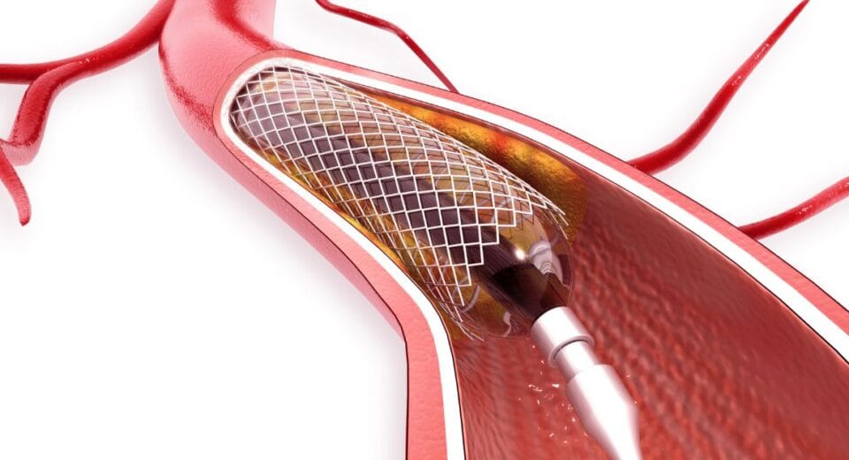 angioplasty cost