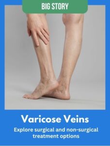 Big Story Newsfeed - Varicose Veins