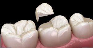 Cracked Tooth Treatment