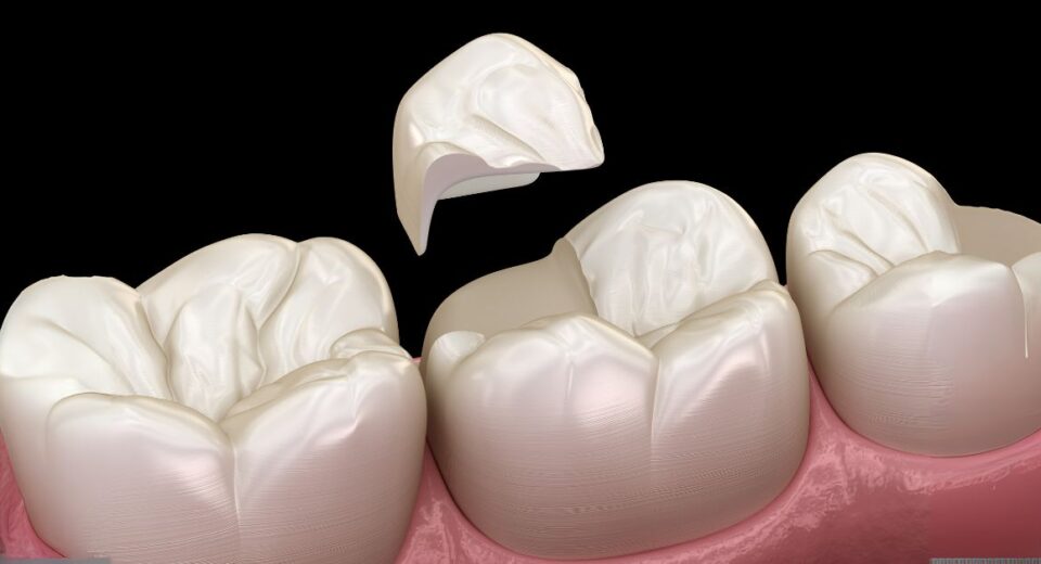 Cracked Tooth Treatment