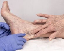 how much does varicose vein treatment cost