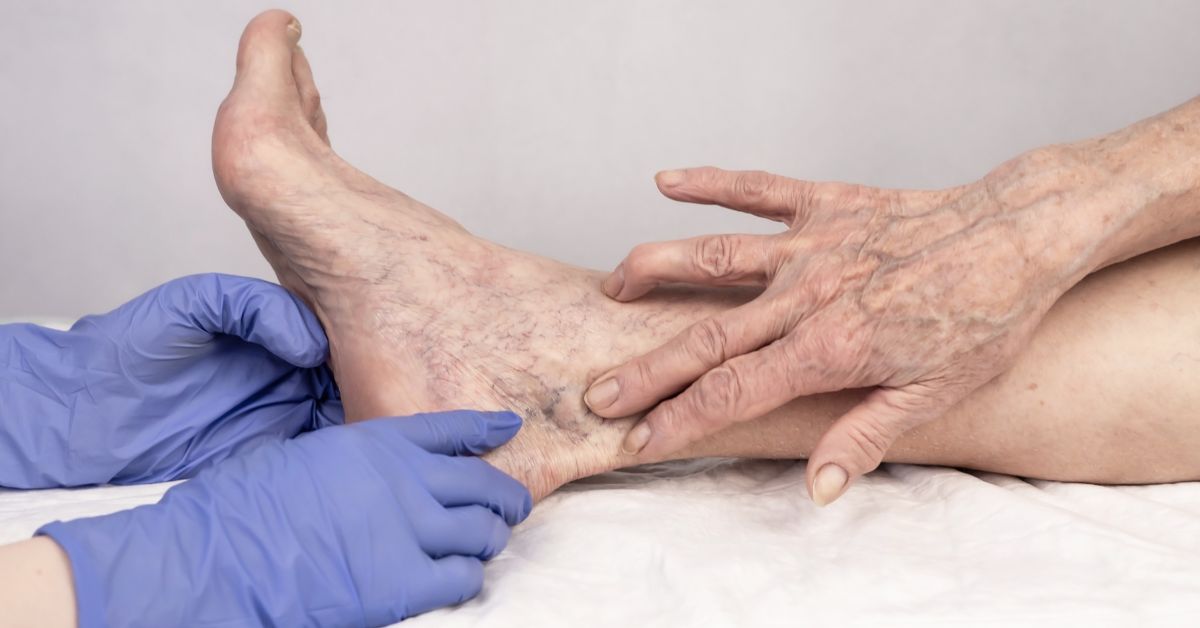 how much does varicose vein treatment cost
