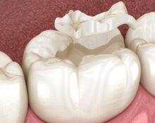 how to fix a cracked tooth