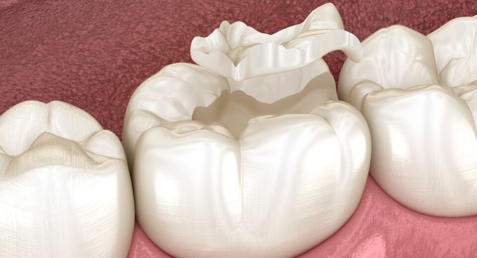 how to fix a cracked tooth