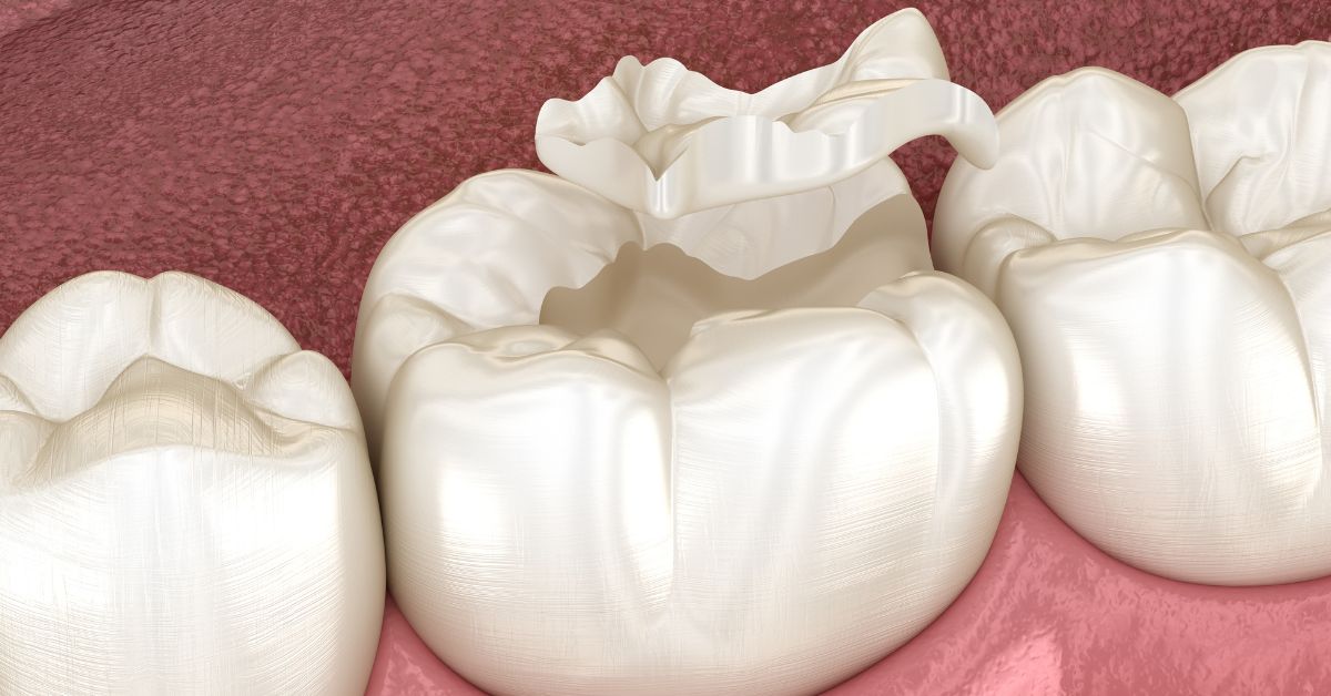 how to fix a cracked tooth