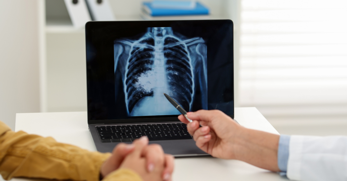 lung cancer screening cost