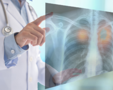 lung cancer singapore