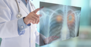 lung cancer singapore