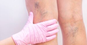 surgical treatment for varicose veins
