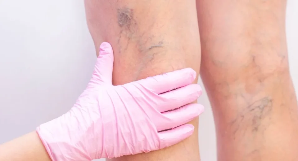 surgical-treatment-for-varicose-veins-cn