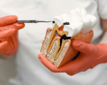 tooth decay treatment