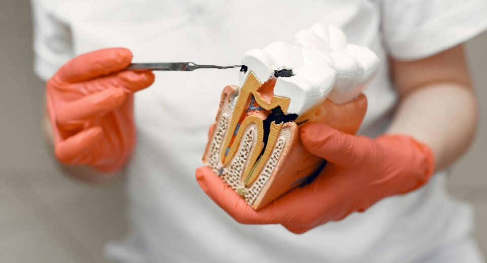 tooth decay treatment