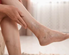 treatment-for-varicose-veins-in-legs-cn
