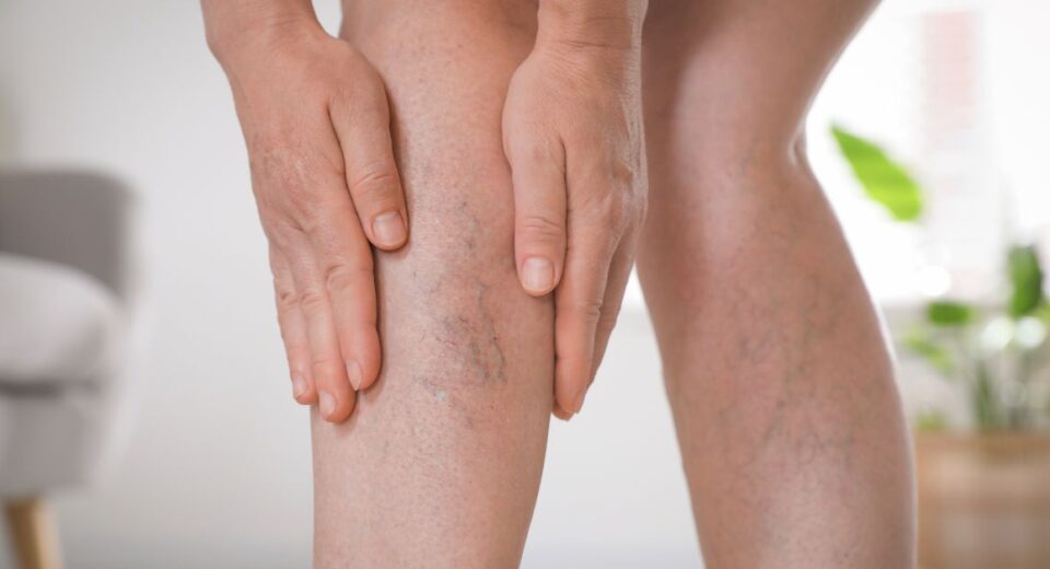 varicose veins treatment