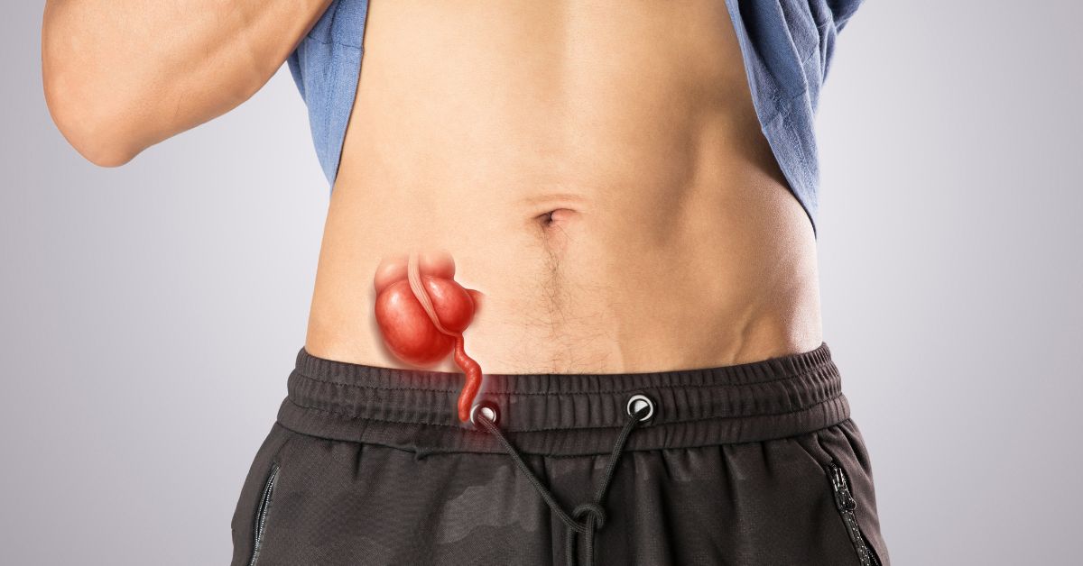 appendectomy singapore