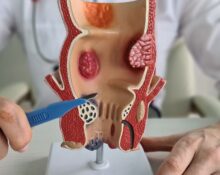 rectal cancer treatment