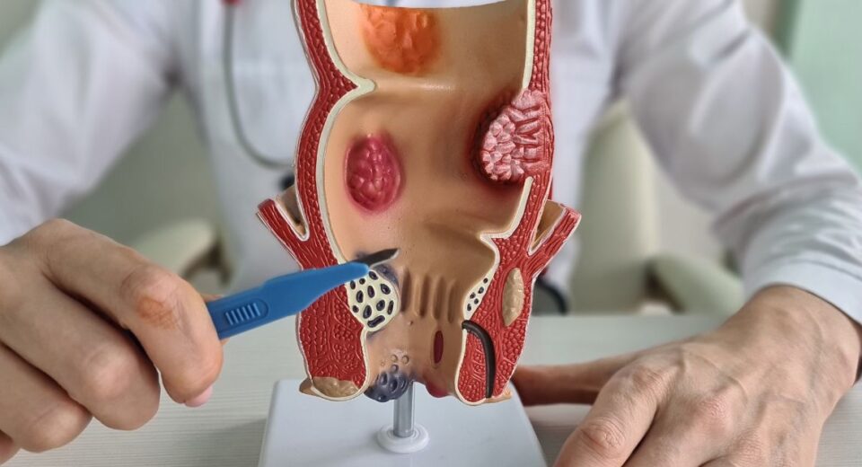 rectal cancer treatment