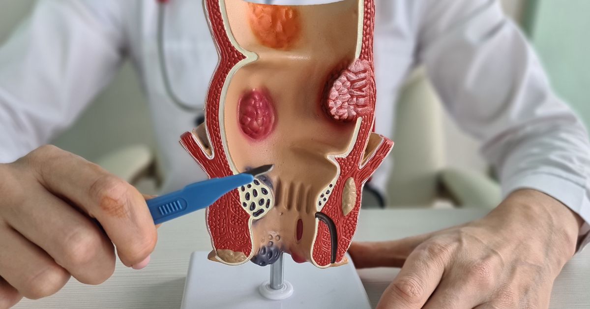 rectal cancer treatment