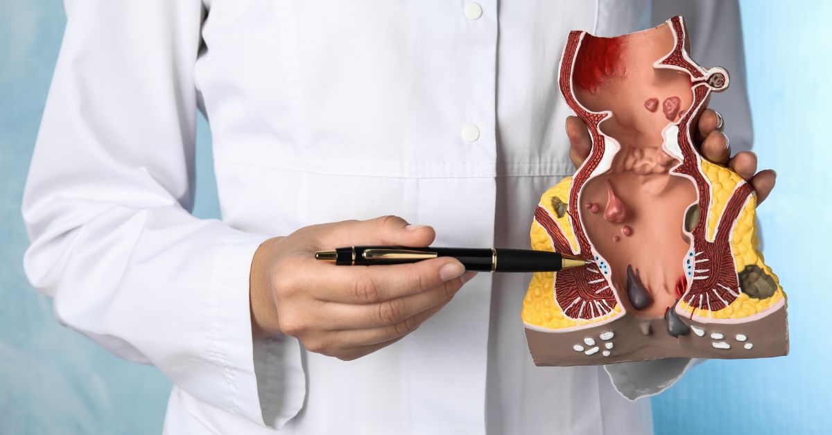 transanal minimally invasive surgery