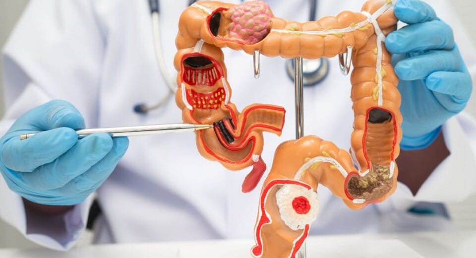colorectal surgery in singapore