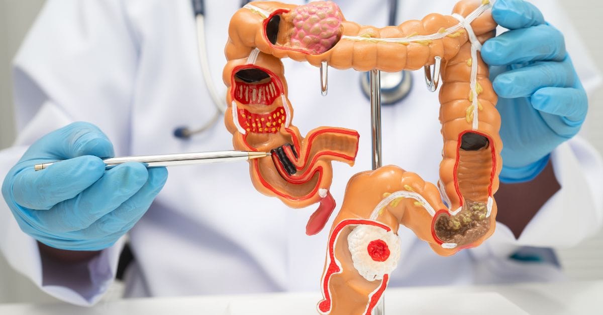 colorectal surgery in singapore