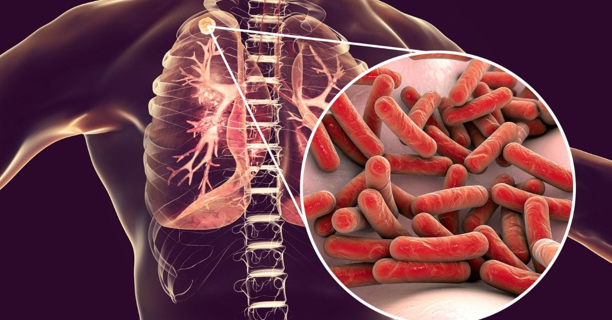 tuberculosis singapore