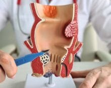 anal fistula surgery singapore