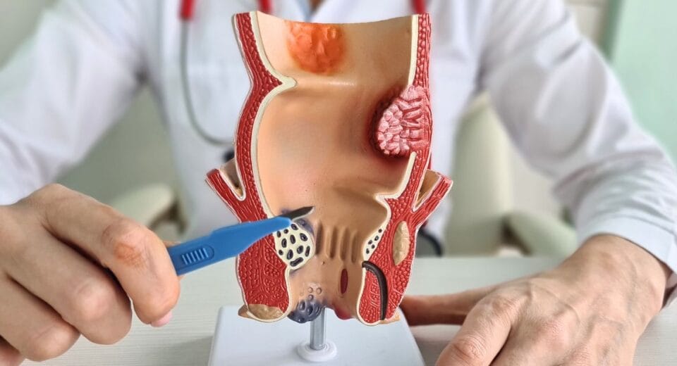 anal fistula surgery singapore